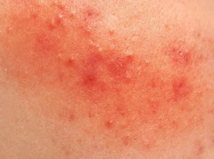 Κοκκινίλες στο σώμα με ή χωρίς φαγούρα. Προσοχή στον έντονο και παρατεταμένο κνησμό